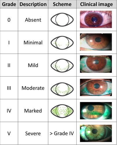 Figure 6 Representation of the Oxford scheme for ocular surface staining.