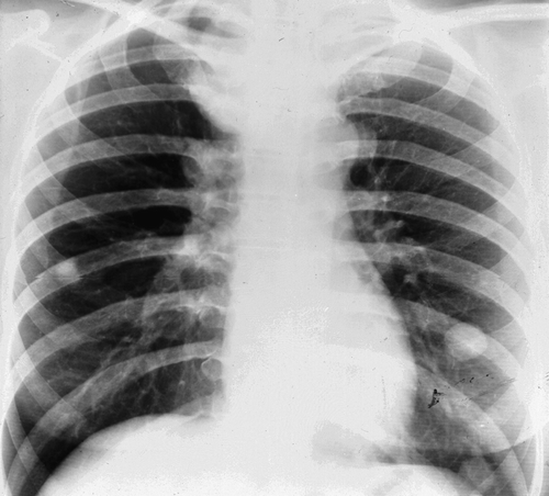Figure 11.  Chest radiography showing two pulmonary metastases in a 38 year old woman with thyroid cancer.