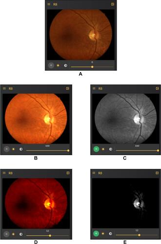 Figure 4 Effect of brightness modification and green channel. (A) Difficulty in locating fovea due to dark macular region. (B) Easier fovea and macula localization. (C) Distinguishing artery and veins in the green channel is easier. (D and E) Contrast change in green channel makes it very easy to assess optic cup and optic disc for glaucoma verification.