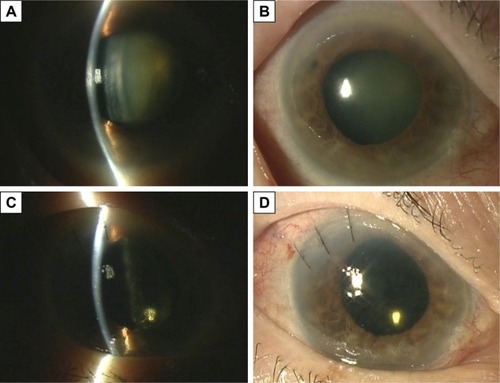 Figure 3 Case 1: Preoperative anterior segment of the right eye.