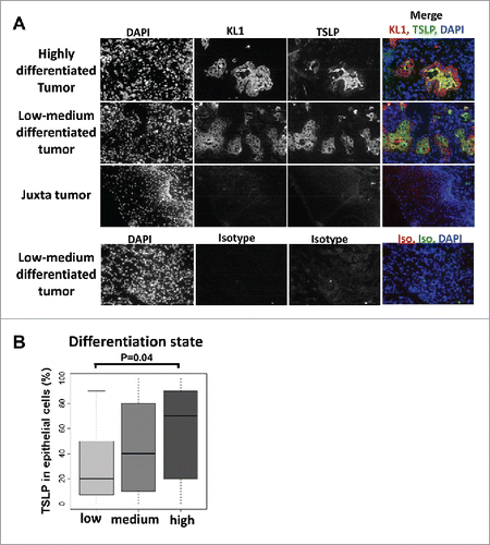 Figure 2. TSLP expression is associated with high differentiation status of HNSCC tumors. (A) Frozen sections of tumors or juxta-tumors samples were stained for DAPI, cytokeratin (KL1), and TSLP by immunofluorescence. (B) Bar plot representation of the percentage of TSLP expression, quantified by immunohistology, in epithelial cancer cells according to the differentiation status of the tumors. Horizontal bars indicate the median. p value is significant if p < 0.05.