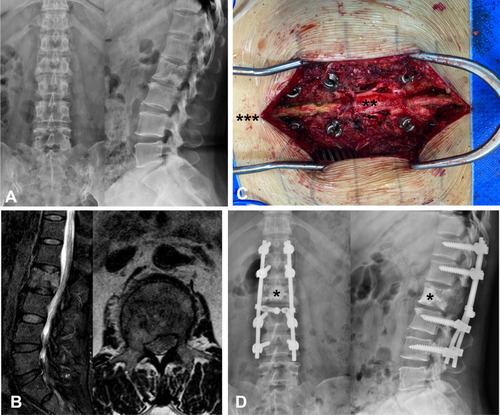 Figure 3 Illustration of conventional surgery. (A) Preoperative X-ray showing bone destruction of L2 vertebra. (B) Preoperative MRI showing metastatic epidural spinal cord compression due to collapsed L2 metastatic lesion. (C) conventional open decompression was performed through a posterior central incision. (D) Postoperative X-ray showing the implants. (asterisk *, bone cement; double asterisk **, dural sac; triple asterisk ***, cephalic).