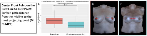 Figure 15. The centre front point on the bust line to bust point measurement (midline to most projecting point) for the participants who underwent bilateral implant-based reconstruction significantly decreased after implant-based reconstruction (right breast: p = 0.002, left breast: p = 0.003). (A) Boxplot (median and interquartile range) of the centre front point on the bust line to bust point measurement at baseline and post-reconstruction for the right breast (left was similar). (B) The centre front point on the bust line to bust point measurement on an exemplar patient at baseline. (C) The centre front point on the bust line to bust point measurement on the same patient post-reconstruction.