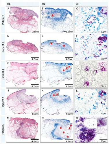 Figure 1. Histopathological overview over 5 of the early ulcerative lesions. Sections were either stained with Haematoxylin-Eosin (HE; A, D, G, J, M) or Ziehl-Neelsen/Methyleneblue (ZN-M; B, C, E, F, H, I, K, L, N, O) according to the WHO standard protocol.Citation1 Pictures were either taken with a Leica DFC 420C camera or with an Aperio ScanScope XT. The border of the tissue area affected by the disease is indicated with a black line in the HE staining (A, D, G, J, M). For patients one and 2 cross sections through the entire lesions are shown (A, D), lesions of patients 3 to 5 (G, J, M) were too large to be entirely processed and therefore only half of the lesion is shown with the necrotic lesion core in the upper right corner. ZN staining (B, E, H, K, N) revealed that AFB were exclusively found in the necrotic areas (red stars). Predominantly clusters of extracellular bacteria were present (C, I, O), however close to the infiltration belt extra- as well as intracellular bacteria (F, L) were observed. Similar findings were made for all 12 lesions analyzed