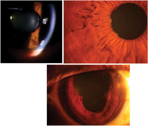 FIGURE 5. Large keratic precipitates with Koeppe nodules on the pupillary margin and broad posterior synechiae in ocular tuberculosis