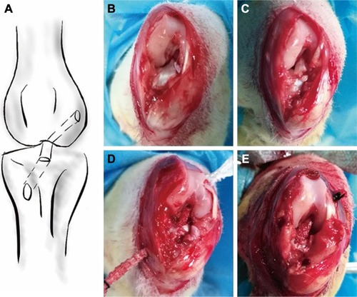Figure 1 Scheme of the procedure for ACL reconstruction using artificial ligament.Notes: (A) Schematic graph of reconstructed ACL using artificial ligament. (B) Excision of the articular capsule and exposure of the ACL. (C) Splitting of ACL. (D) Graft passing through the bone tunnel. (E) Fixation of the graft to periosteum using nonabsorbable suture.Abbreviation: ACL, anterior cruciate ligament.