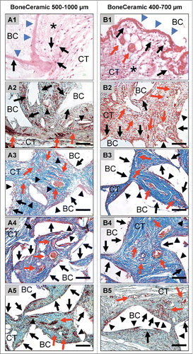 Figure 2. shows the tissue reactions as well as the vascularization pattern of the 2 analyzed bone substitute granule types, BoneCeramic 500–1000 μm and BoneCeramic 400–700 μm. A1 and B1: On day 3, a surface layer composed of fibrin and connective tissue fibers (blue arrows) was observed on the surface of both materials, while the granules (BC) were embedded within an fiber-rich and loose connective tissue (CT) (H&E-staining, 400x magnification, scale bars = 10 µm). A2 – A3 and B2 – B3: On days 10 and 15, the interspaces of both bone substitute granules (BM) were filled up by a cell- and vessel-rich (red arrows) connective tissue (CT). At the surfaces of both granule sizes mainly mononuclear cells (black arrows) were detectable beside low numbers of multinucleated giant cells (arrow heads) (A2 and B2: Movat Pentachrome-stainings; A3 and B3: Azan-stainings; 400x magnification, scale bars = 10 µm). A4 – A5 and B4 – B5: On days 30 and 60 both granule sizes of the bone substitute (BC) were still surrounded by a cell- and vessel-rich (red arrows) connective tissue (CT). Also primarily mononuclear cells (black arrows) were found at the surfaces of both materials, while increased numbers of multinucleated giant cells (arrow heads) were found in the implantation beds of BoneCeramic 400–700 μm (B4 and B5) compared with those of BoneCeramic 500–1000 μm (A4 – A5) (A4 and B4: Azan-staining; A3 and B3: Movat Pentachrome-staning; 400x magnification, scale bars = 10 µm).