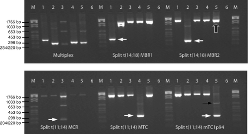 Figure 2.  Multiplex PCR for detection of t(11;14) and t(14;18). M: molecular marker. Lane 1: cell line DOHH-2, lane 2: cell line WSU-NHL, lane 3: lymph node biopsy from patient no. 261, lane 4: cell line JVM-2, lane 5: blood from patient no. 28, and lane 6: ddH2O. Multiplex PCR: primers amplifying MBR1, MBR2, and MCR in t(14;18) as well as MTC and mTC1p94 in t(11;14). Split reactions: 5 primer sets detecting t(14;18) MBR1, t(14;18) MBR2, t(14;18) MCR, t(11;14) MTC, and t(11;14) mTC1p94. A control gene (TCF20) is co-amplified in all lanes. White arrows show the translocation positive PCR products in the split reactions, large black arrow exemplifies a PCR product of the control gene, while the thin black arrow exemplifies a weak germline PCR band.