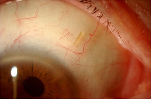 Figure 6 Lower-lying filtering bleb in XEN45 gel implant at 6 months.