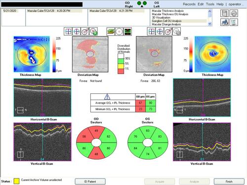 Figure 2 Representative screen-capture for GCIPL analysis on the Cirrus SD-OCT.