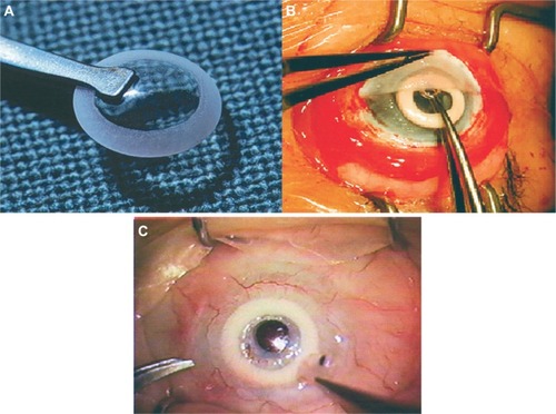 Figure 2 AlphaCor keratoprosthesis.