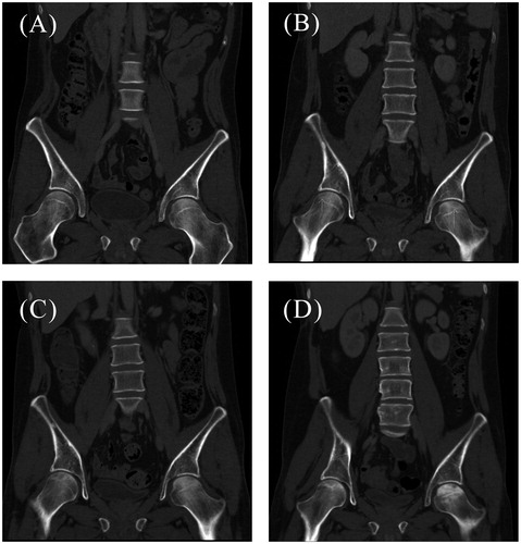 Figure 2. CT scans (A-D) of the patient’s hip region showing the different stages of AVN. (A) Normal femoral heads bilaterally, one year after diagnosis of ES (20 January 2014). (B) Initial signs of necrosis bilaterally (arrows) with radiolucency, 14 months after diagnosis (26 March 2014). (C) Progression of osteonecrosis with radiolucencies and sclerosing lines, 17 months after diagnosis (12 June 2014). (D) Increasing sclerosis of the left femoral head, 19 months after diagnosis (4 August 2014).