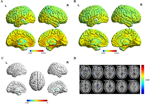 Figure 2 Spatial of distributions of FC patterns of the right hippocampus in HM patients and HCs.
