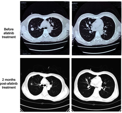 Figure 1 Thoracic computed tomography images illustrating the size reduction of the pulmonary lesions after 2 months of afatinib treatment (lower panels) as compared to baseline (top panels).