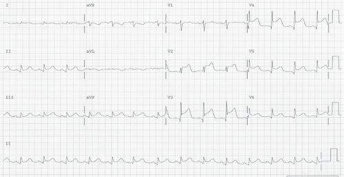 Figure 1 The ECG for case one demonstrated prominent ST elevations in the anterior and inferior leads.