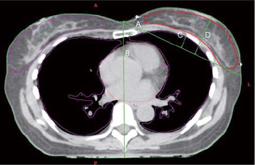 Figure 1. Four thorax shape parameters are defined; A = Tangential diameter, B = central diameter, C = Lung orthogonal diameter and D = breast orthogonal diameter.