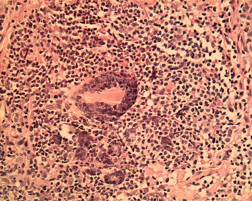 Figure 2.  Multinucleated giant cells with pleomorphic nuclei. HE, X 250.