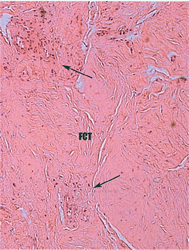 Figure 4. Histology of biopsy of an area of grafted bone obtained at rerevision for cup loosening (see Figure 3). No radiographic evidence of graft incorporation.