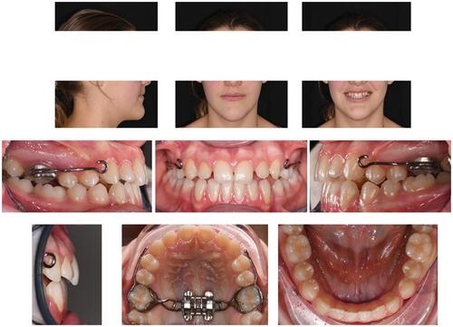 Figure 13 Facial and intraoral pictures after facemask therapy.