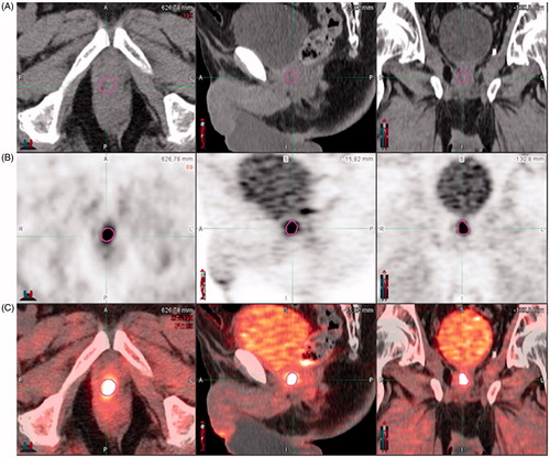 Figure 1. Biological target volume (BTVRELAPSE) located on the vesico-urethral anastomosis and outlined using the gradient-based algorithm (PET-Edge) provided by MIM-Vista® (6.5.2, MIM Software Inc., Cleveland, USA). (A) CT image. (B) 18F-FCH PET images. (C) Registration.