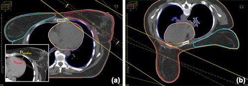 Figure 1. Typical PTV and OAR contouring and field setup in the supine (a) and prone (b) positions. The shortest distance between the anterior surface of the LAD and the chest wall (dmedian) and the surface area of the heart in the radiation field (Aheart) are measured at the middle of the LAD in the supine position (insert).