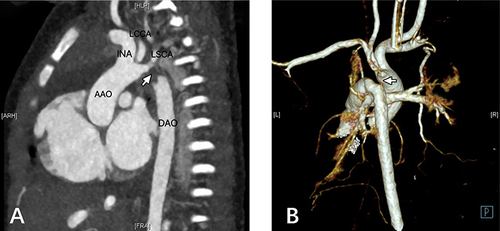 Figure 2 (A) CT angiography. White arrow represents the lumen of the aortic arch’s descending transition segment is obstructed, with an affected length of approximately 0.45 cm. (B) Vascular 3D reconstruction techniques. White arrow represents the atretic aortic arch. No finer bundles were detected in the atretic areas.