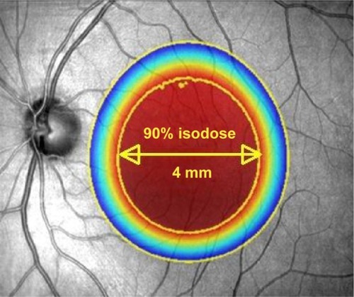 Figure 2 Illustration to show the attenuation effect of the three collimated beams to deliver 90% of the desired radiation dose to a 4 mm diameter at the macula.