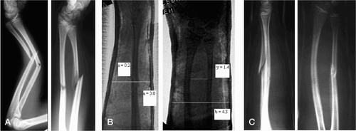 Figure 3. A. Fractures with 100% displacement. B. After reduction, with cast index a/b = 0.69, padding index (x/y) = 0.14, and Canterbury index = 0.69 + 0.14 = 0.83. C. After 3 weeks, showing no re-displacement.