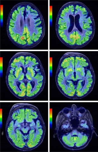 Figure 5 Coregistered PET and MR images in axial views in different levels demonstrating generalized brain atrophy, more prominent in the posterior frontal lobe, and hypometabolism of both cerebral hemispheres that was especially pronounced in the middle and posterior part of the left frontal lobe. Diffusely decreased metabolism was noted in the basal ganglia.