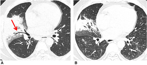 Figure 5 Lobar pneumonia in a 64-year-old man. (A) CT imaging showed consolidation with air bronchogram (red arrow) in the right middle lobe. (B) After two weeks of antibiotics treatment, thoracic CT showed the area of consolidation in the right middle lobe was reduced, which means the condition improved.