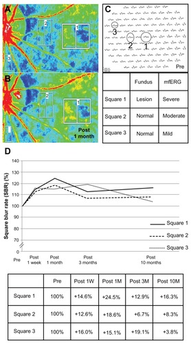 Figure 3 (A and B) Composite color map using square blur rate (SBR) measured by laser speckle flowgraphy; (C) squares were set corresponding to the severity of multifocal electroretinography (mfERG) amplitude reduction; and (D) the changes of the mean SBR at Squares 1–3 during systemic corticosteroid therapy and after 10 months in the left eye. Square 1 indicates the macula, including the acute macular neuroretinopathy lesion with severe mfERG findings; Squares 2 and 3 (moderate and mild mfERG findings, respectively) indicate the sites of funduscopically normal-appearing retinal areas. The red indicates high SBR; the blue indicates low SBR. The SBR in all squares increased 4 weeks after the start of treatment (B) compared with the SBR before treatment (A). The laser speckle flowgraphy was measured ten consecutive times at each visit before treatment, at 1 week and 1, 3, and 10 months after treatment. The mean SBR within each square was calculated at each evaluation point. The mean SBR of all the squares sequentially showed 16.3%, 8.3%, and 3.8% increases at 10 months after treatment compared with the pretreatment level (D).