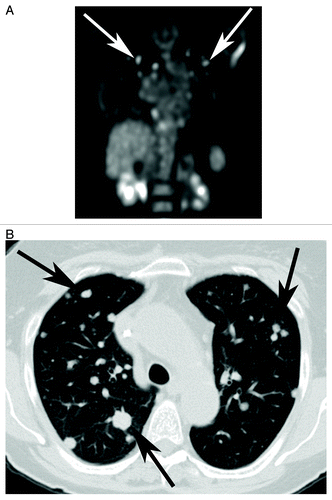 Figure 3. (A) Coronal PET image shows multiple fluoro-18-deoxyglucose (FDG) avid nodules (white arrows) scattered throughout both lungs and right hila region, consistent with thoracic metastatic disease. (B) Axial CT scan obtained at the same time show multiple bilateral pulmonary nodules (black arrows) of various sizes, ranging from a few millimeters to a couple of centimeters, consistent with pulmonary metastasis form colorectal cancer. There was no appreciable change in lesion size or FDG avidity with treatment.