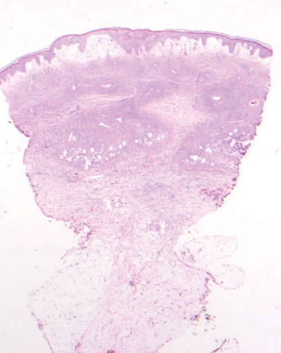 Figure 4. 2X. Sections show a punch biopsy of skin. There is subepidermal edema with erythrocyte extravasation, Many superficial and deep dermal small vascular channels are surrounded by neutrophils and nuclear dust.