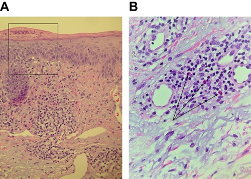 Figure 2 Skin biopsy from the back showing spongiotic dermatitis with eosinophilia: (A) spongiosis with confluent parakeratosis, focal mounds of neutrophils and crust formation. (B) Superficial perivascular inflammatory infiltrate consisting of lymphocytes, histiocytes, plasma cells and arrows pointing to eosinophils.