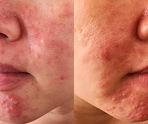 Figure 4 Multiple inflammatory papules, nodules, pustules, and whiteheads around the mouth accompany redness and swelling on the face. (Case 3).