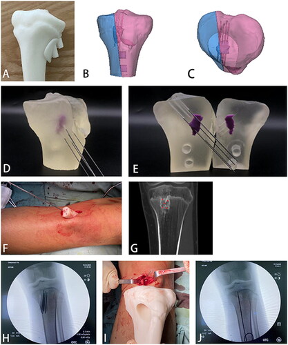 Figure 7. (A) Photosensitive resin No. 128 material printed three-dimensional bone model and positioning guide plate; (B,C) Three-dimensional bone model of SG material (transparent) with lesion area hollowed out and split in its position; (D,E) Sectional view of the guidewire and lesion impacted with the guide plate; (F) Guidewire impacted through the guide plate; (G,H) Comparison of preoperative CT planning and intraoperative guidance steel needle; (I) Complete excision of the lesion through the minimally invasive incision; (J) The steel needle was used to explore the excavated lesion’s edge without damaging the normal physis.