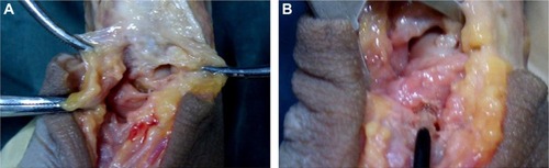 Figure 2 Surgical procedure for scaphoid fixation using an ASS.