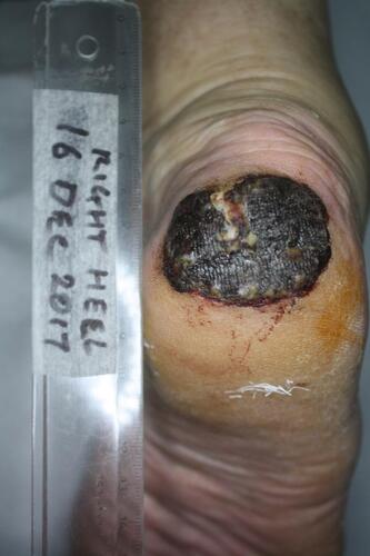 Figure 1 Melanoma of right heel. Right heel, with a black, well-defined plaque. There is evidence of bleeding and there is a white fissure stretching from 12 o’clock to the centre of the lesion.