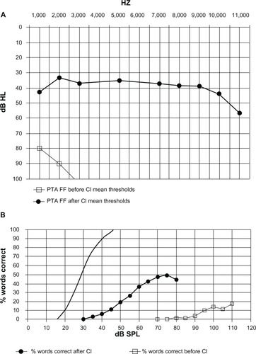 Figure 1 Results of free field audiometric tests in elderly patients before and after cochlear implantation.