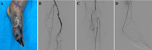 Figure 1 The patient’s left foot on admission and digital subtraction angiography findings. (A) Necrosis of the big toe with bluish-purple skin lesions on the foot; (B–D) Digital subtraction angiography showing patent superficial femoral artery, but the popliteal artery and the anterior tibial artery is occluded.