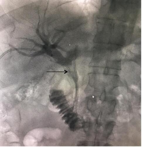 Figure 2 Common bile duct stent partial occlusion with filling defects (fungus balls) at the tip of the black arrow.