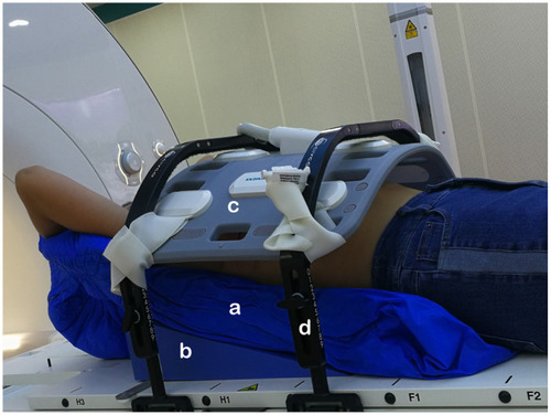 Figure 1 Magnetic resonance simulation body positioning system of immobilized patients. a, styrofoam; b, wedge plate; c, radiofrequency coils; d, adjustable bridges.