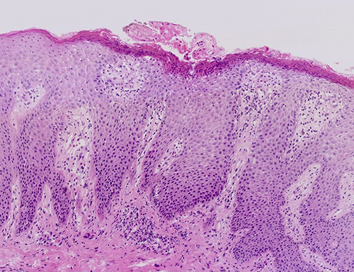 Figure 3 Anatomopathological examination of white pustules revealed epidermal hyperkeratosis with fused dyskeratosis, neutrophilic microabscesses in the dyskeratotic stratum corneum, reduced or even absent granular layer beneath the dyskeratosis, hypertrophy of the spinous layer, upwardly displaced dermal papillae, dilated capillaries, superficial perivascular lymphocytes, and scattered neutrophil infiltration (HEx40).