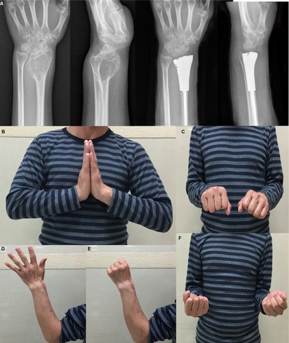 Figure 8 A 46-year-old mañ18 months after the resection of Campanacci grade III GCTs of the distal radius with 3D prosthetic reconstruction.Notes: (A) Radiographic comparison between preoperative joint and postoperative joint. (B) Dorsiflexion of affected side could reach 70° after the surgery. (C and F) Pronation and supination were good. (D and E) Movement and sensation of finger and thumb were satisfactory.Abbreviations: 3D, three-dimensional; GCT, giant cell tumor.