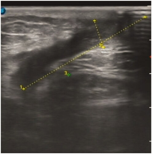 Figure 3. B-Mode Ultrasound Image of case 2 (b).