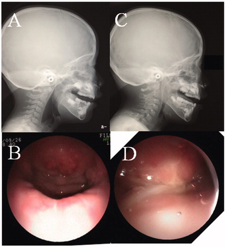 Figure 6. Findings of NPS and LPG. (A) LPG during phonation before the first operation. No contact between the posterior pharynx and soft palate (black arrow). (B) NPS midline view of the velopharyngeal valve during phonation before the first operation. A large defect is seen. (C) LPG during phonation after the second operation. The space between the posterior pharynx and the soft palate is completely closed (black arrow). (D) NPS midline view of the velopharyngeal valve during phonation after the second operation. The space between the posterior pharynx and the soft palate is completely closed.