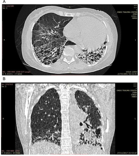Figure 3 (A) Axial chest CT of the lung window showing reticular opacities, honeycombing, thickening of septae, and ground glass attenuation. (B) Coronal reformatted chest CT of the lung window showing honeycombing with basal predominance worse on the left and mosaic pattern, loss of left lung volume, and ground glass attenuation in the right lower lobe.