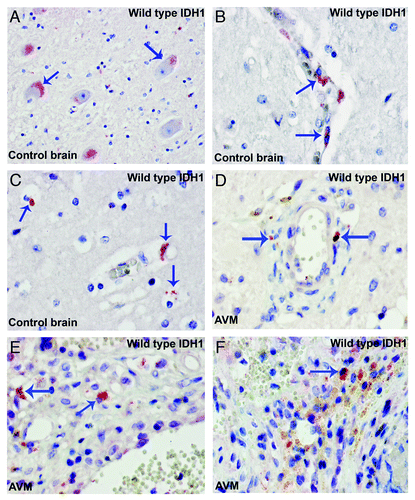 Figure 2. Wild type IDH1 is expressed in neuron and microglia/macrophages. (A) Control brain. WT IDH1 is expressed in neuron (arrows). (B) Control brain. WTIDH1 is expressed in perivascular microglia (arrows). (C) Control brain. WTIDH1 is expressed in parenchymal microglia (arrows). (D to F) WTIDH1 is expressed in microglia/macrophages present in samples of arteriovenous malformations (AVM) (arrows).