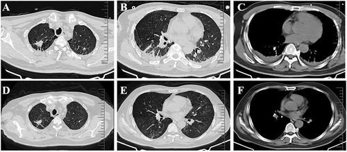 Figure 1 Chest CT scan at admission (A-C) and 2 months after antituberculosis therapy (D-F).