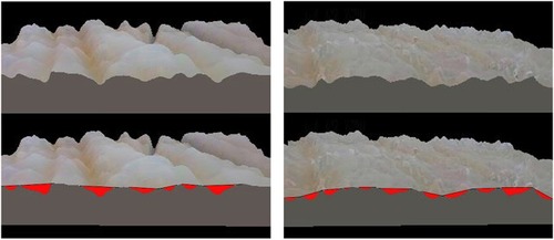 Figure 1 Skin roughness was evaluated by the areal topography with an optical technique using a microscope. Surface mapping was made, and the patchwork method was determined by the sum of triangle areas (1/2× base × height of a triangle). Before treatment, the sum of the triangle areas was 366 (left panel). Seven months after treatment, the sum of triangle areas decreased to 231.5, and it revealed that roughness of skin improved in the ischial area after multi layered calcium hydroxylapatite (CaHA) injection (right panel).